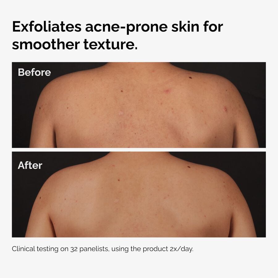 the-body-care-collection-r4 ord-salicylic-acid-body-serum-before-after-graphic-NA.jpg