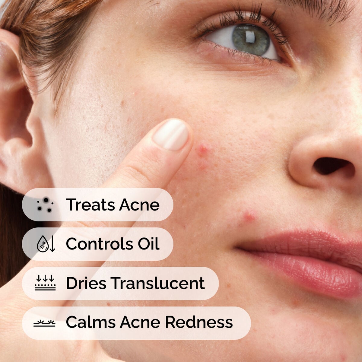 sulfur-10-powder-to-cream-concentrate-i5 ord-sulfur-10pct-powder-to-cream-concentrate-model-application-with-benefits-acne.jpg